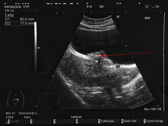 Figure 2: Bladder Nodule