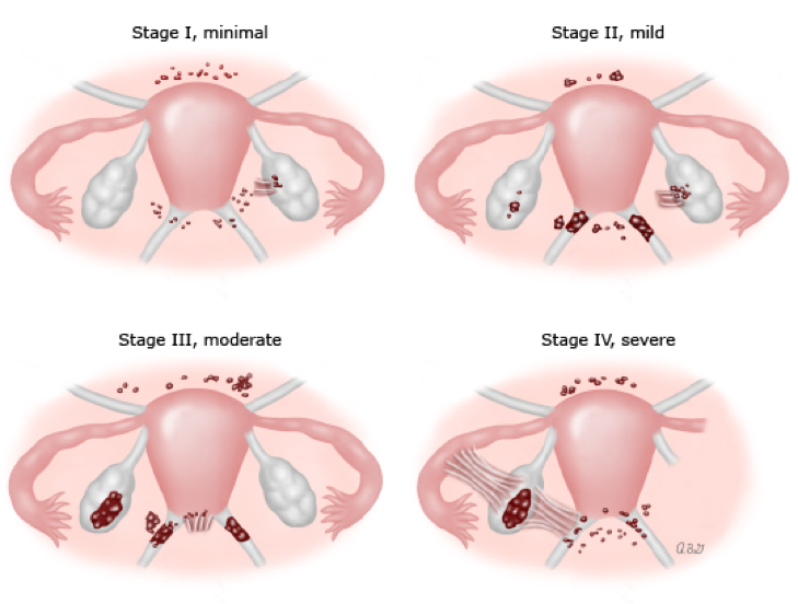 Figure 5: Staging of endometriosis