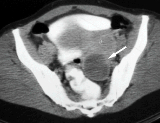 Figure 1: Endometrioma