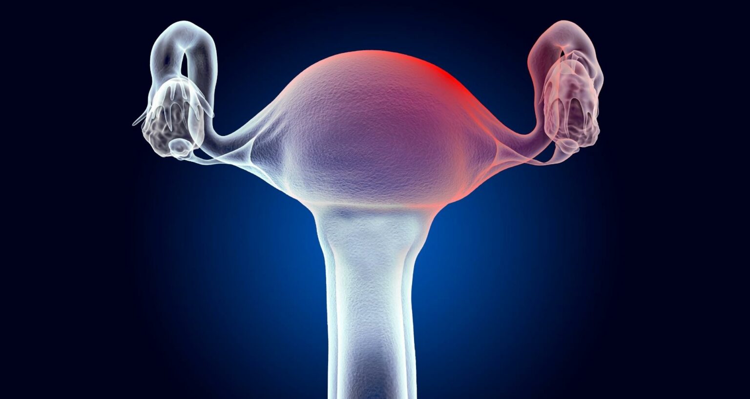 ADENOMYOSIS Brisbane Centre for Endometriosis